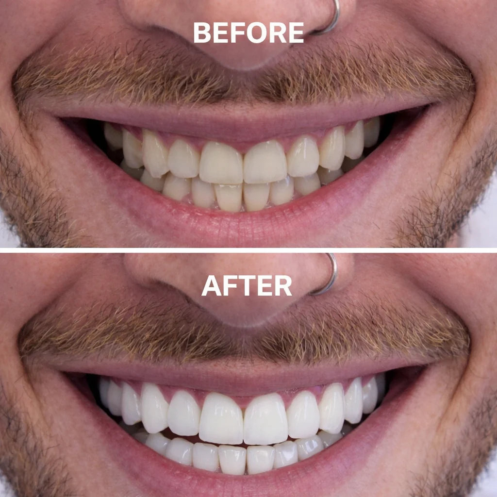 Glowbite™ Teeth Whitening Strips
