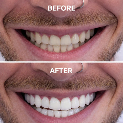 Glowbite™ Teeth Whitening Strips